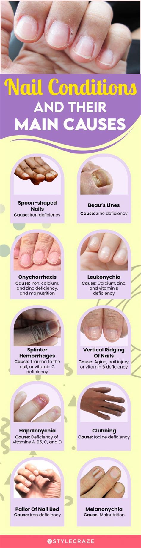 fingernail deficiencies.